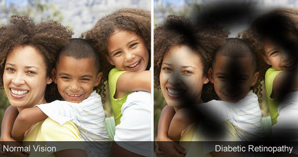 Understanding Diabetic Retinopathy: The Silent Threat to Vision